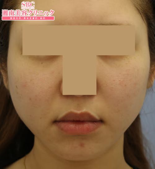 【女性・輪郭】美ボディ脂肪吸引_aftar