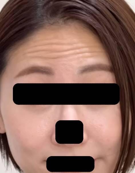 銀座スキンクリニックでしわ取り：マイクロボトックスを受けたYooさんの写真