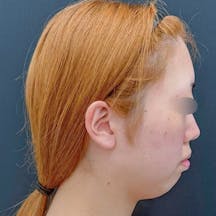 【女性・小顔】根こそぎVASER脂肪吸引・ジョールファット除去術_before