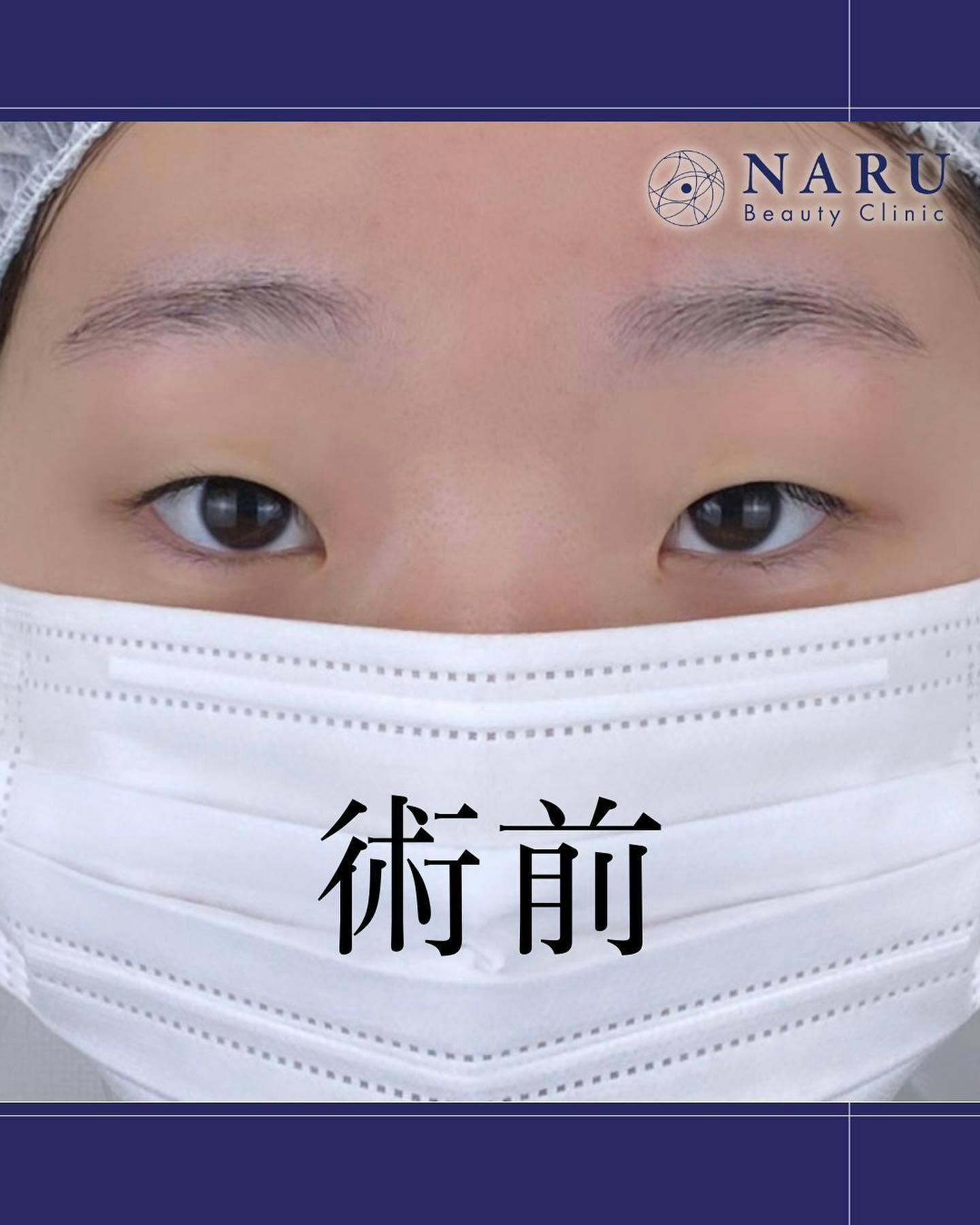 【女性・目元】二重埋没法_before