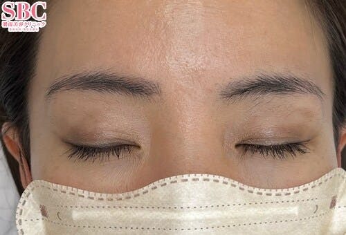 【女性・眉】医療アートメイク、アートメイク(眉毛)_before