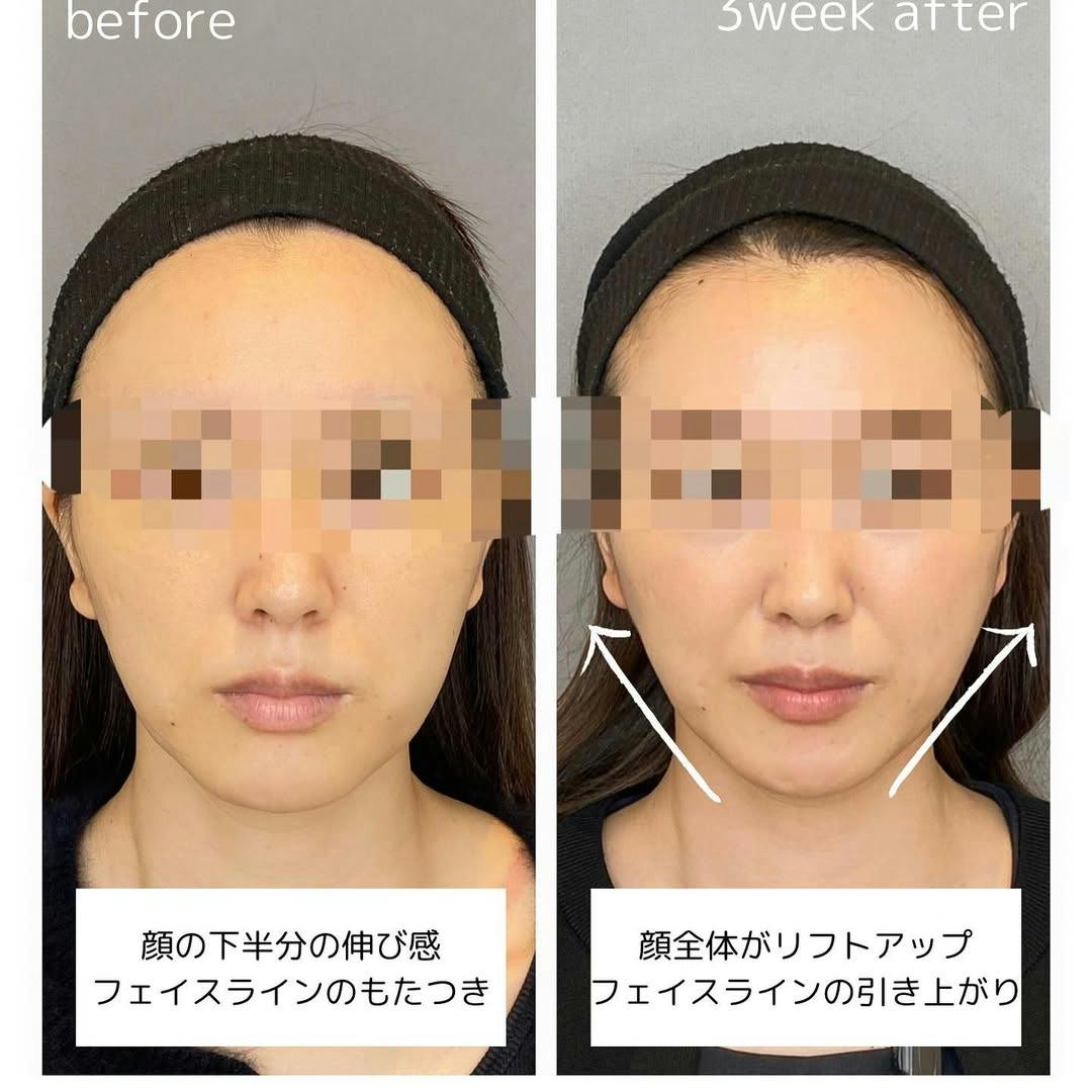 【女性・たるみ】糸リフト_before_aftar
