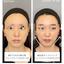 【女性・たるみ】糸リフト_before_aftar