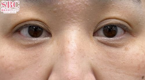 【女性・クマ】目の下の切らないクマ・たるみ（ふくらみ）取り ナチュラル脂肪注射コンデンスリッチ ナチュラル脂肪注射ナノリッチ_after