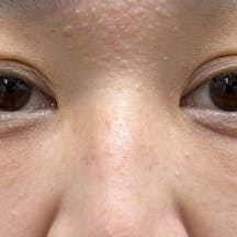 【女性・クマ】目の下の切らないクマ・たるみ(ふくらみ)取り ナチュラル脂肪注射コンデンスリッチ ナチュラル脂肪注射ナノリッチ_after