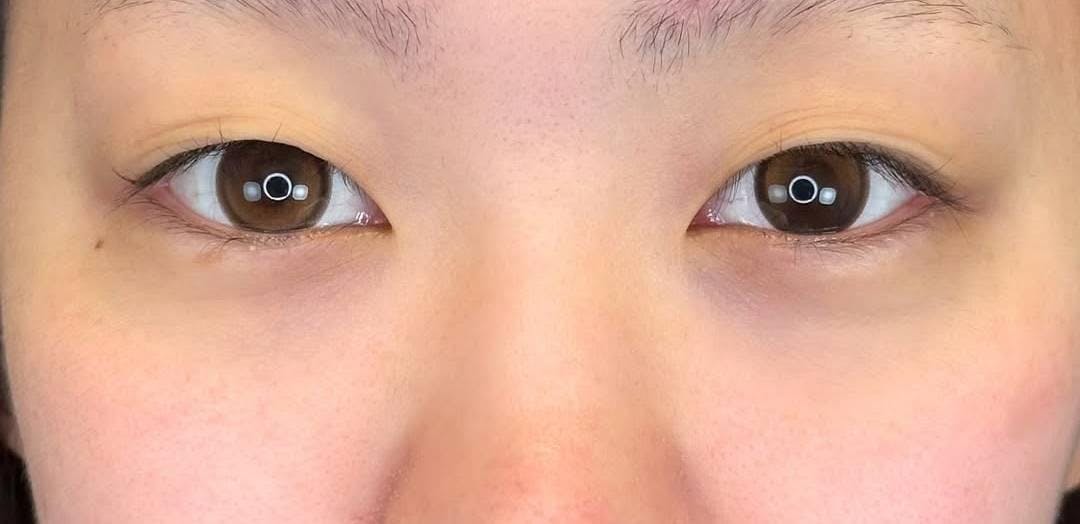湘南美容クリニック 渋谷院で二重埋没法：Teen二重（両目2点）を受けためいぷるさんの写真