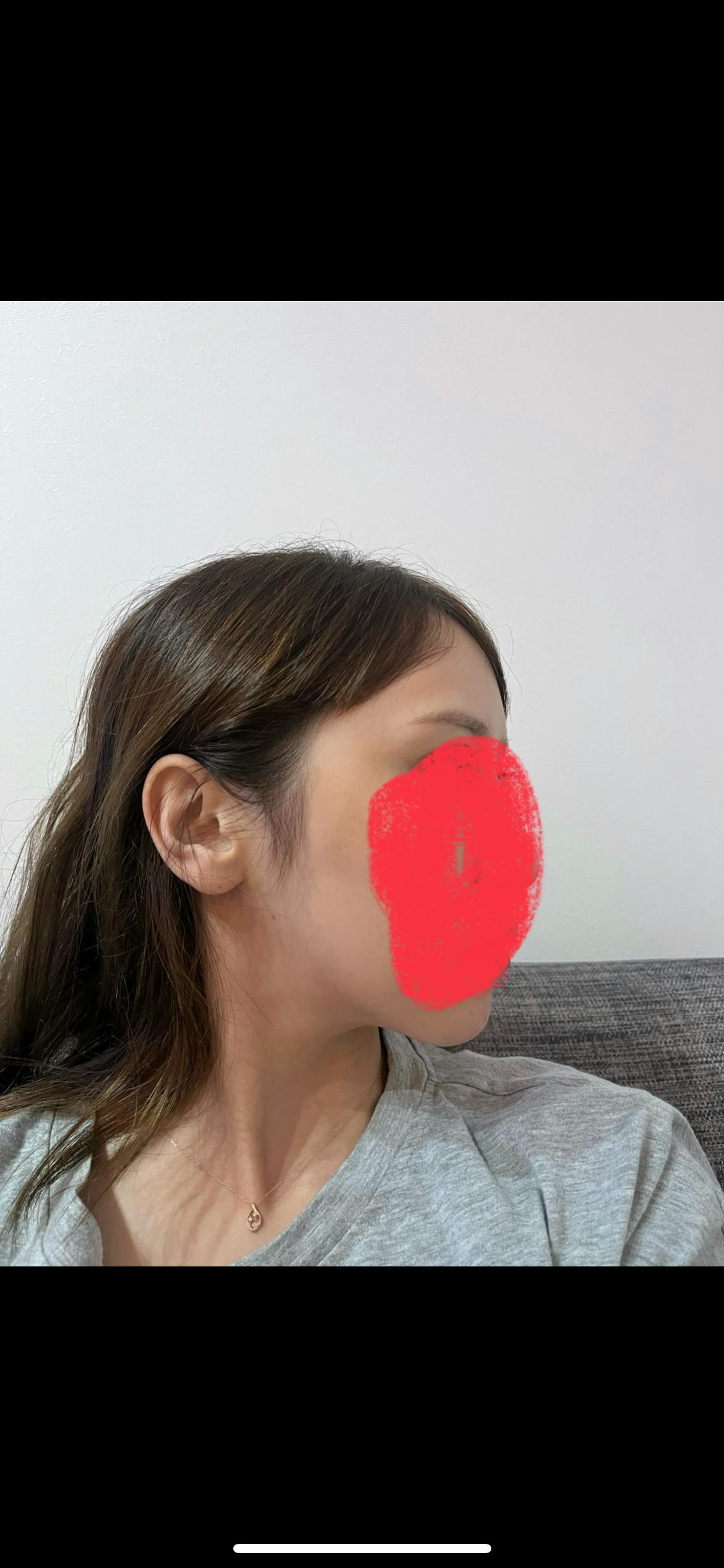 モーブビューティークリニック札幌大通(Mauve Beauty Clinic 札幌大通)でブラックピール(ケミカル・カーボンピーリング)を受けたelleriさんの写真