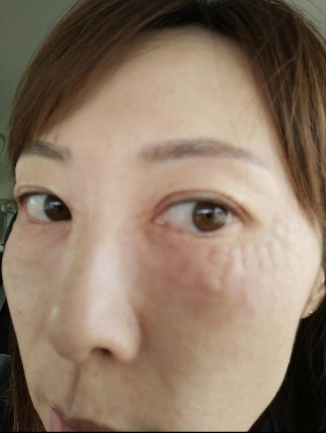 湘南美容クリニック 長野院で女優注射を受けたりょうさんの写真