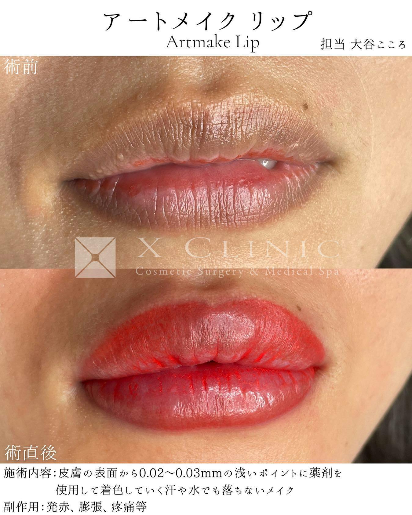 【女性・唇】リップアートメイク_before_aftar