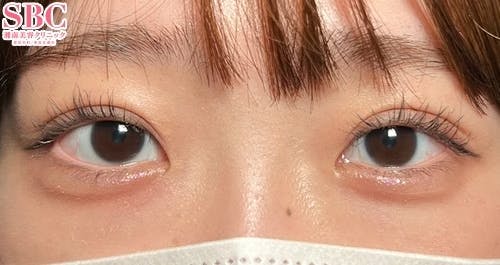 【20代女性・目元】クイックコスメティーク・ダブルNeo、ヒアルロン酸涙袋_after