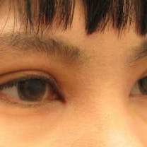 【女性・目元】クイックコスメティーク・ダブルNeo・クイックコスメティーク・シングルNeo・目頭切開プレミアム_aftar