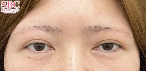 【40代女性・目元】眉下リフト（眉下切開）_aftar
