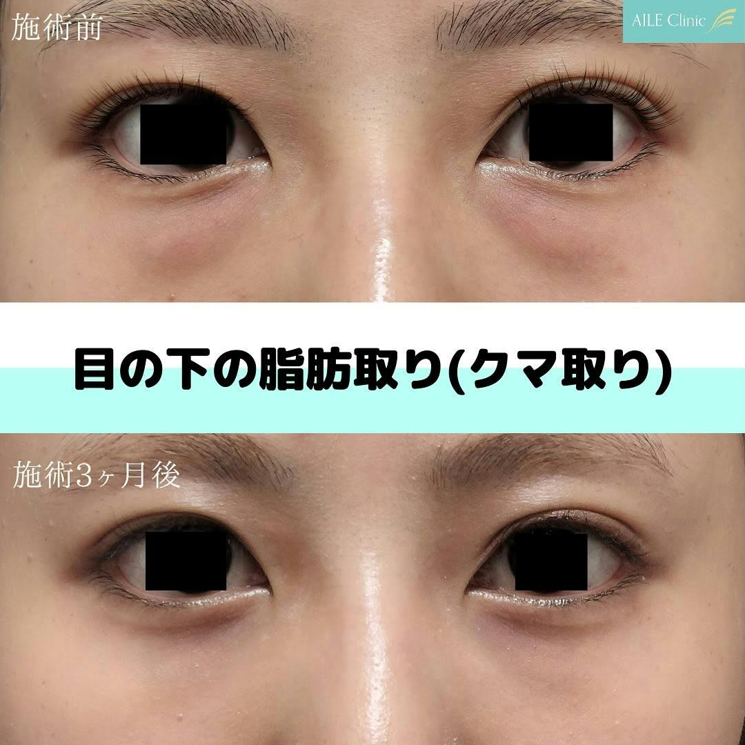 【女性・クマ】目の下の脂肪取り(クマ取り)_before_aftar
