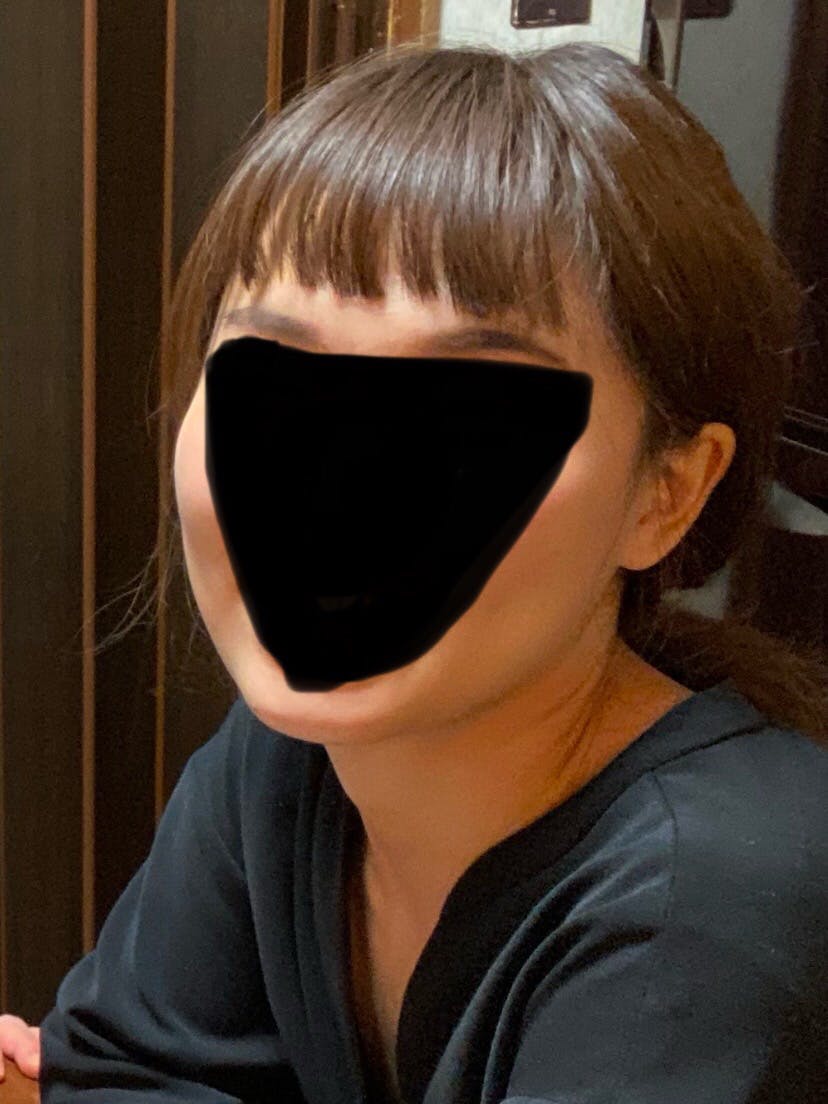 湘南美容クリニック  大阪梅田院でウルトラリフトプラスHIFUを受けた山藤さんの写真