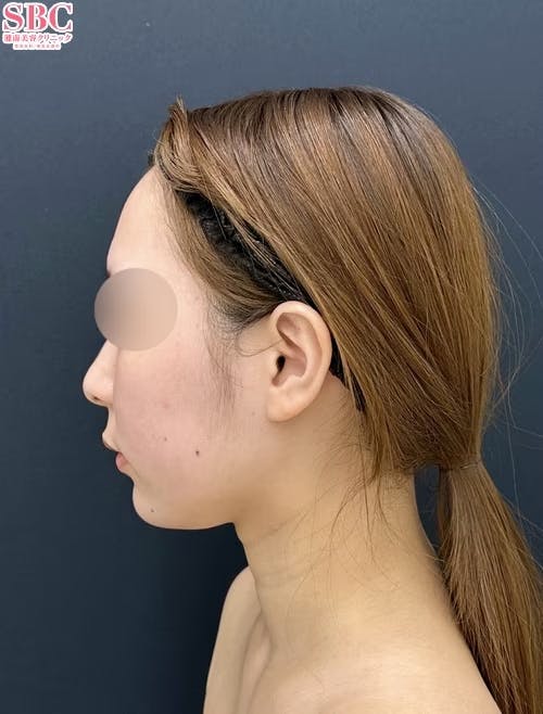 【20代女性・顔】小顔用脂肪吸引注射・その他の治療法・糸リフト_before