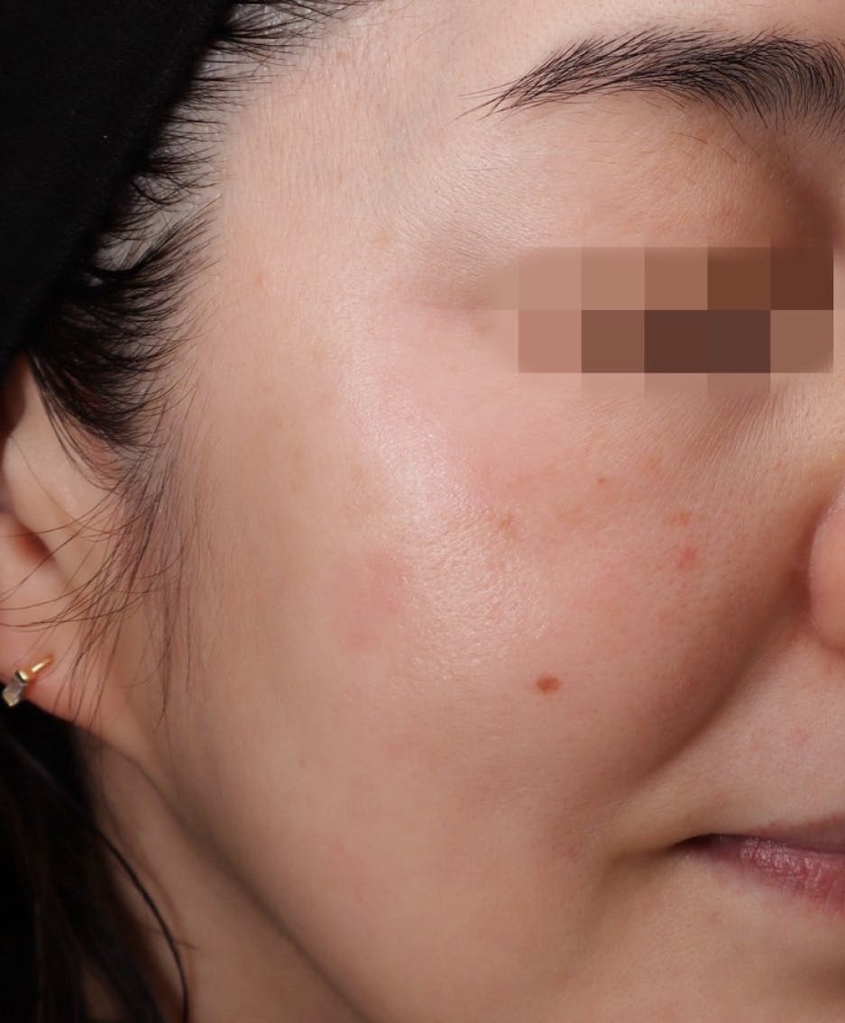 GRACY TOKYO CLINIC リポットレーザー 症例 Afterの画像