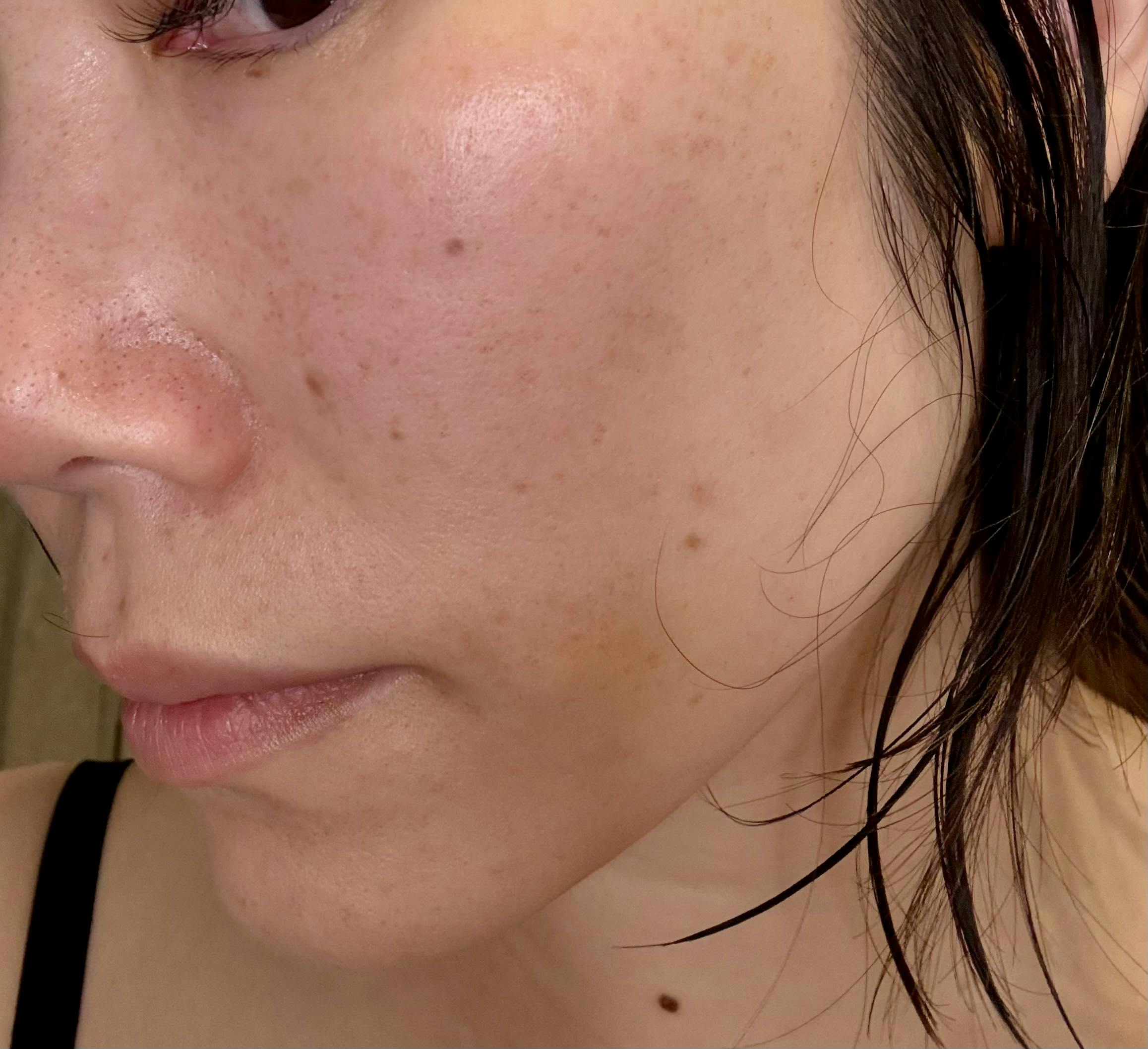 ルラ美容クリニック 新宿院でルメッカを受けたあっこさんの写真