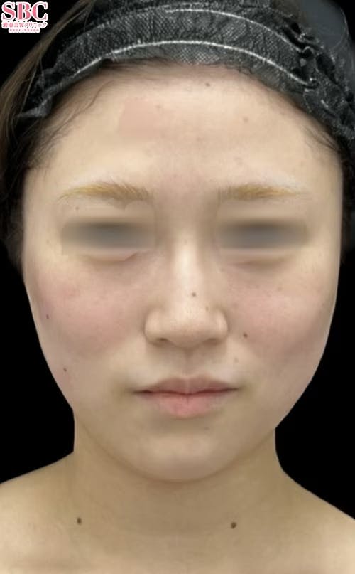 【20代女性・輪郭】プリマリフト_after