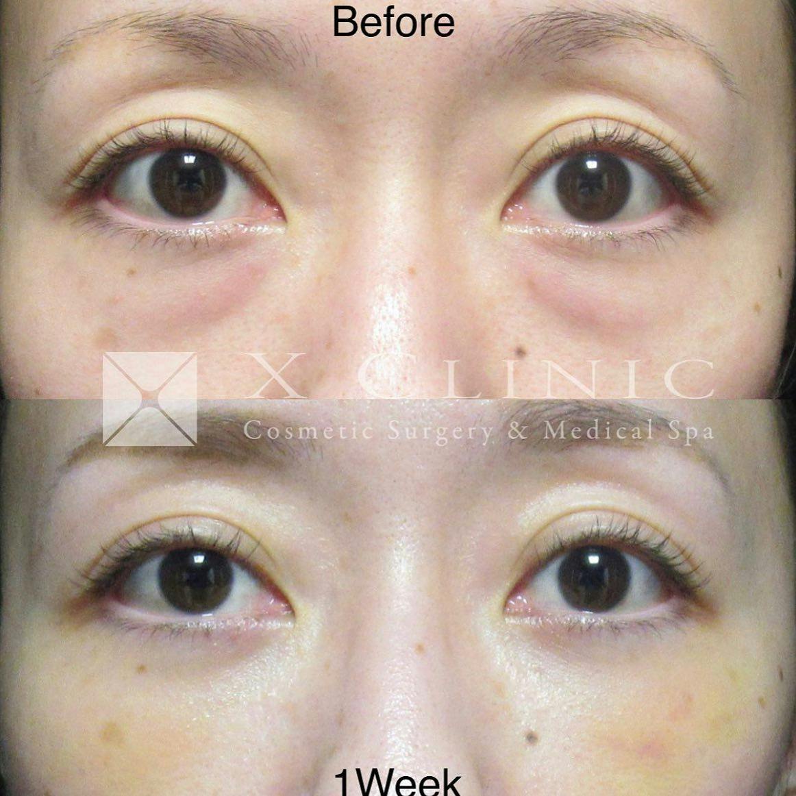 【女性・目元】クマ取りフルコース_before_aftar