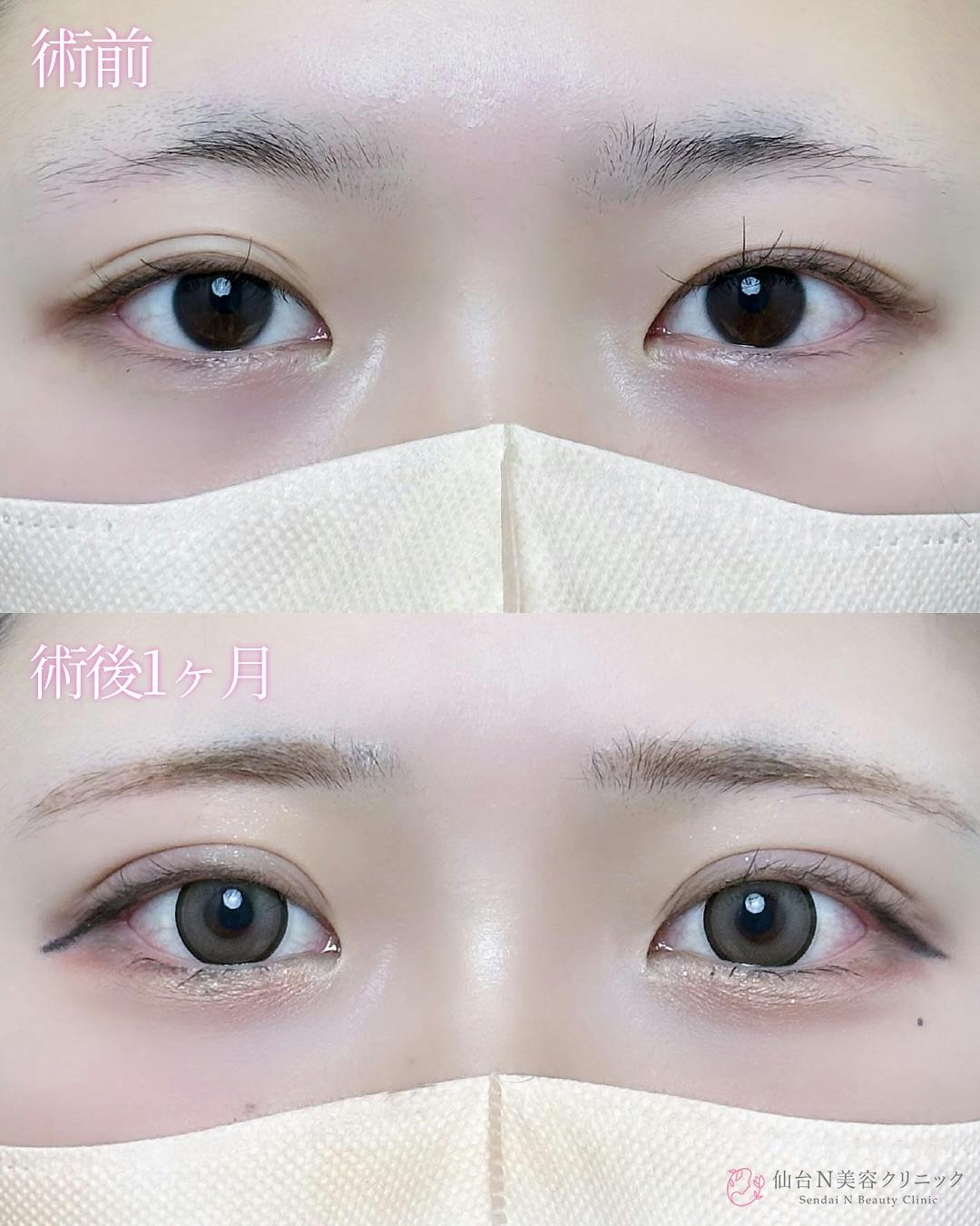 【女性・目元】二重埋没法（シークレットトリプル）_before_aftar