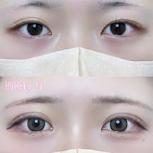 【女性・目元】二重埋没法(シークレットトリプル)_before_aftar