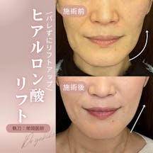 【女性・たるみ】ヒアルロン酸注入_before_aftar
