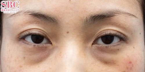 【30代女性・目元】目の下の切らないクマ・たるみ（ふくらみ）取り、ナチュラル脂肪注射コンデンスリッチ、ナチュラル脂肪注射ナノリッチ_before