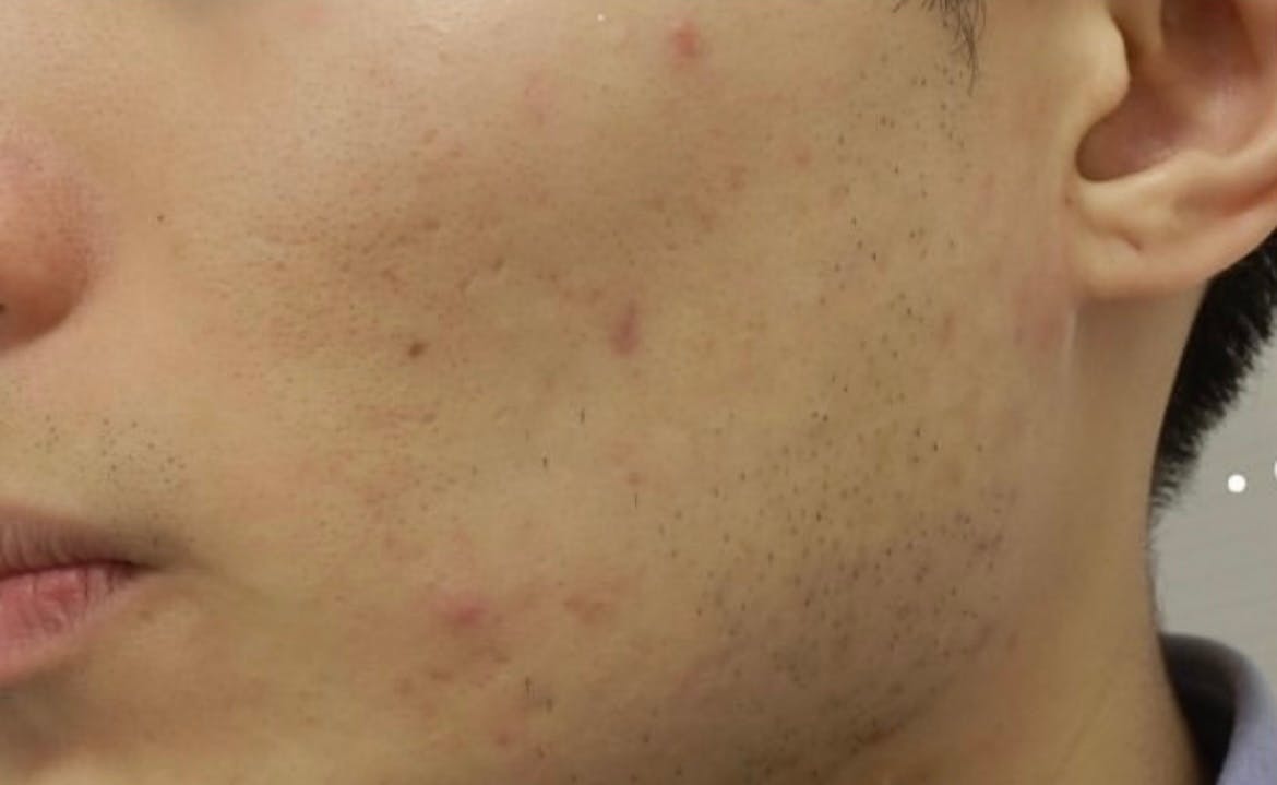 【20代男性・ニキビ】アクネトレント_b1