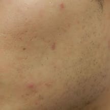 【20代男性・ニキビ】アクネトレント_b1