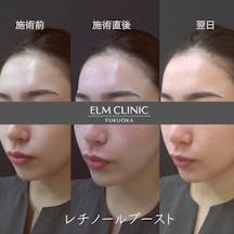 【女性・ハリ】ダーマペン4レチノールブースト_before_aftar