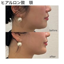 【女性・顎】ヒアルロン酸(顎)_before_aftar