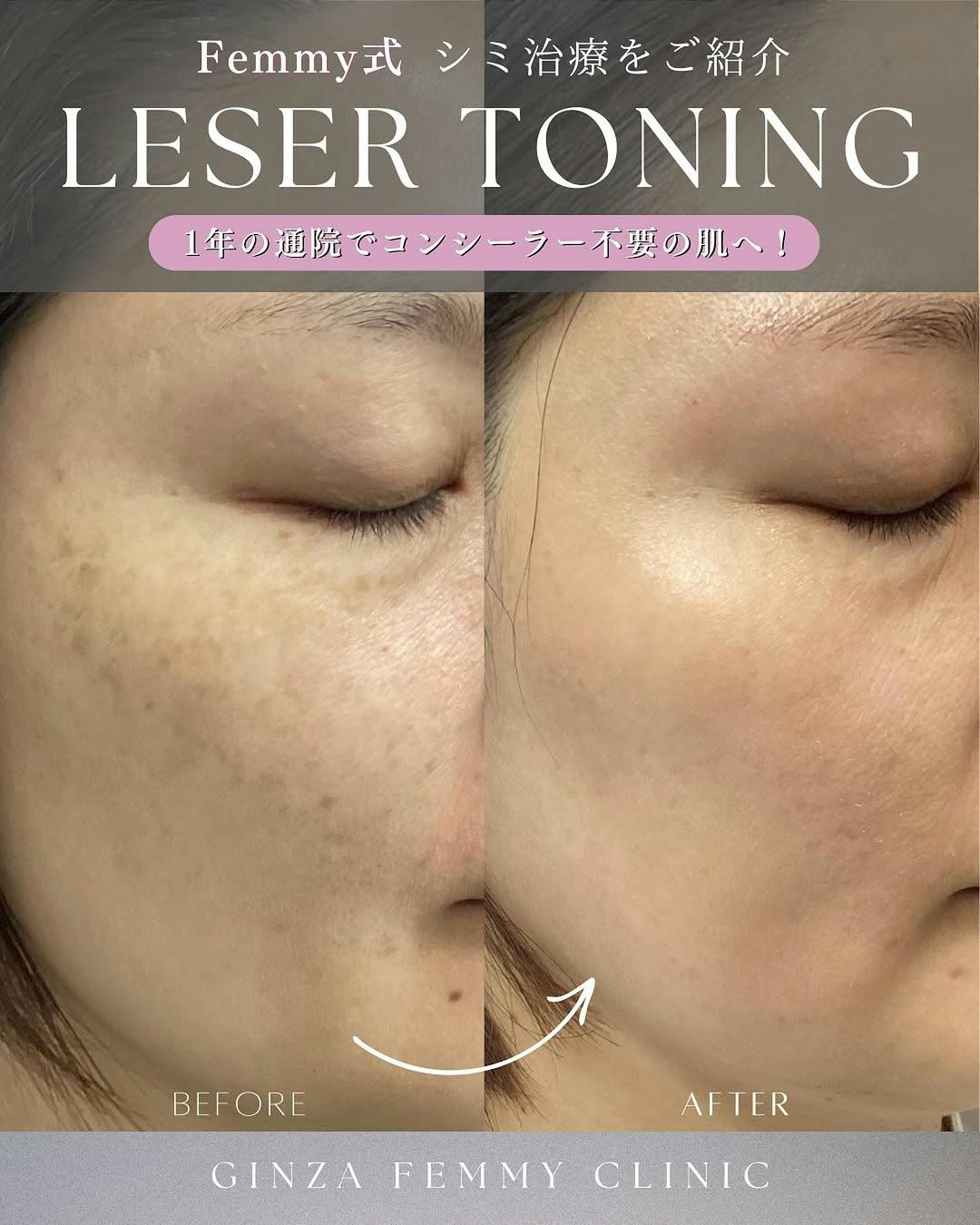 【女性・シミ】シミ治療_before_aftar