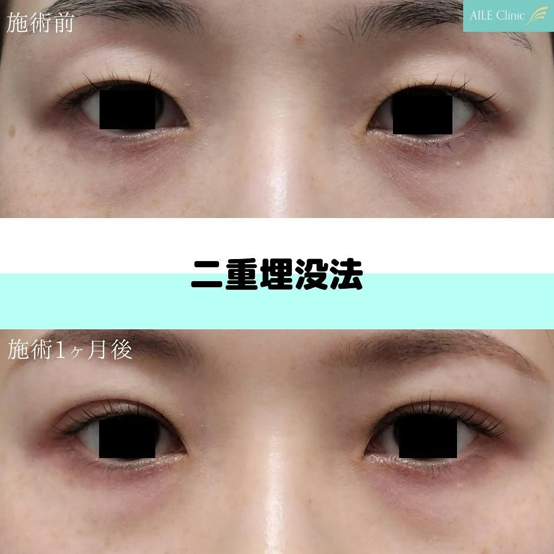 【女性・目元】二重埋没法_before_aftar
