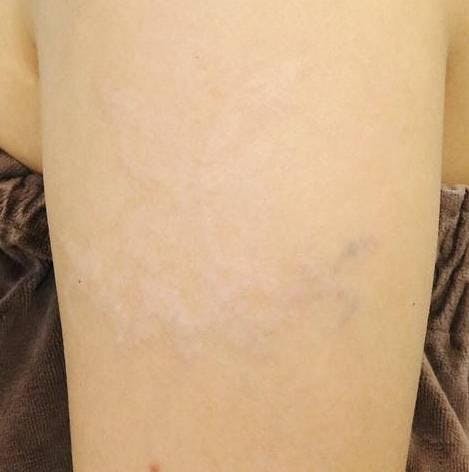 ガーデンクリニック 池袋院でタトゥー（刺青）除去：ピコレーザー治療を受けたZさんの写真