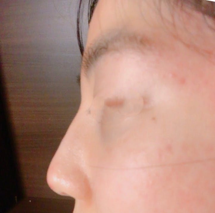 品川スキンクリニック札幌院でヒアルロン酸　鼻根を受けたあやみんさんの写真
