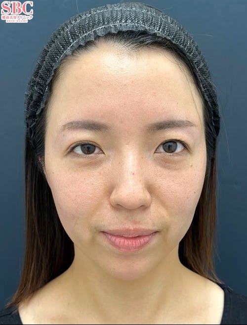 【女性・目元】裏ハムラ法 VOV（ボブ）リフト テスリフト_before