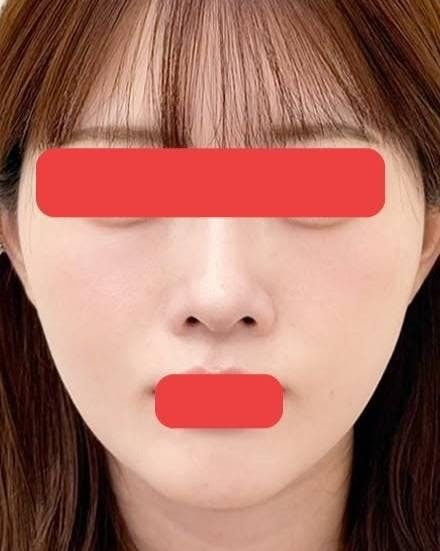 品川美容外科 心斎橋院で糸リフト：美肌アモーレを受けたOkamootyさんの写真