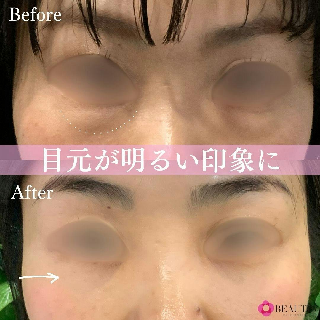 【女性・目元】クマ取り(経結膜脱脂)_before_aftar