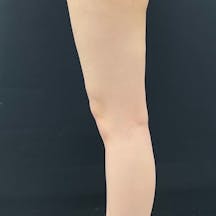 【女性・下半身】Aquicell(アキーセル)脂肪吸引_aftar