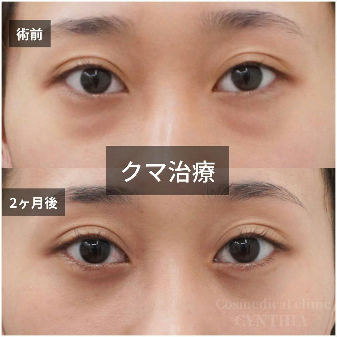 【20代前半女性・目元】目の下のクマ取り_before_aftar