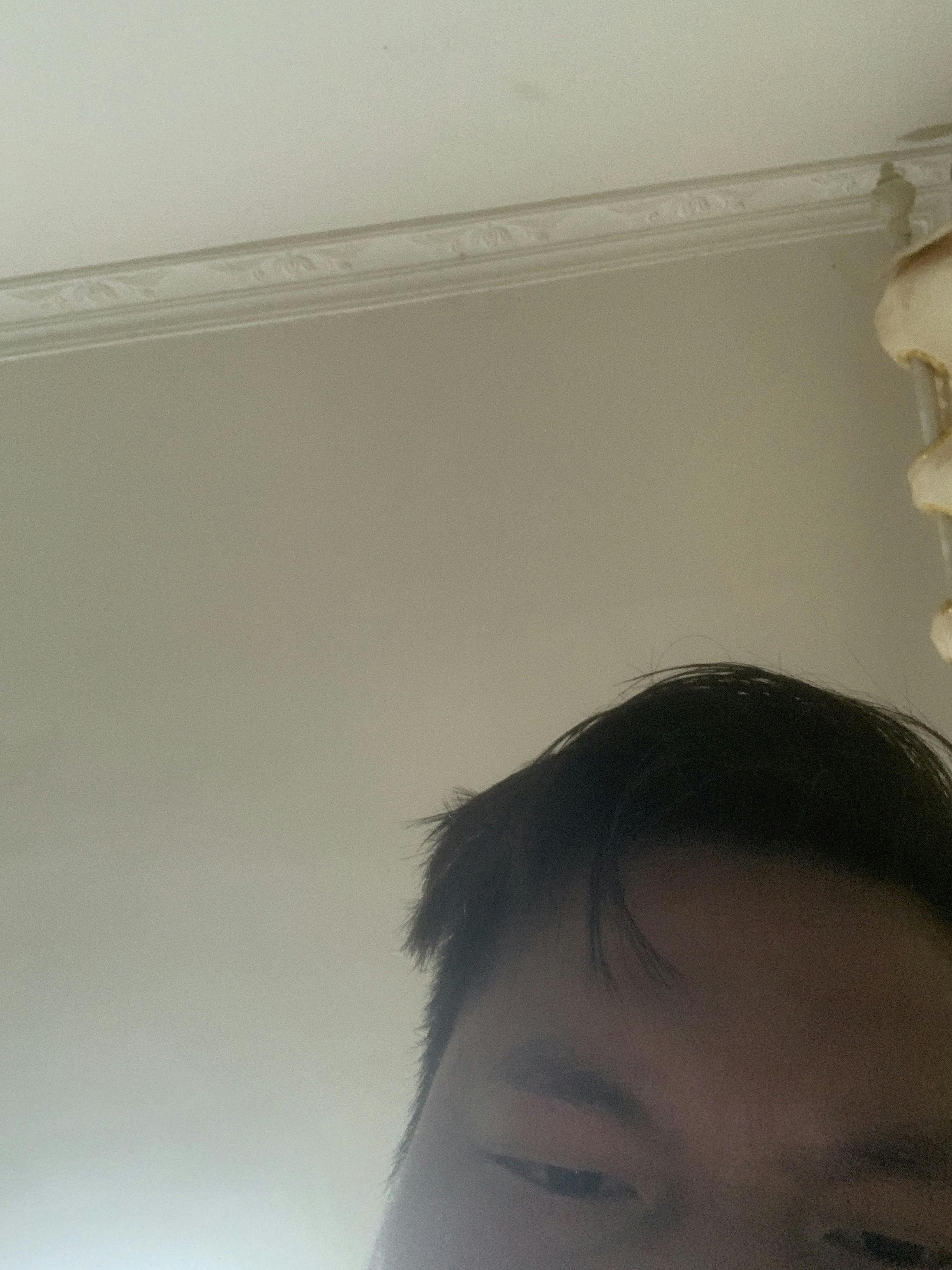 TCB東京中央美容外科 宮崎院で他院修正(二重)・他院抜糸・二重整形を受けたHhghhさんの写真