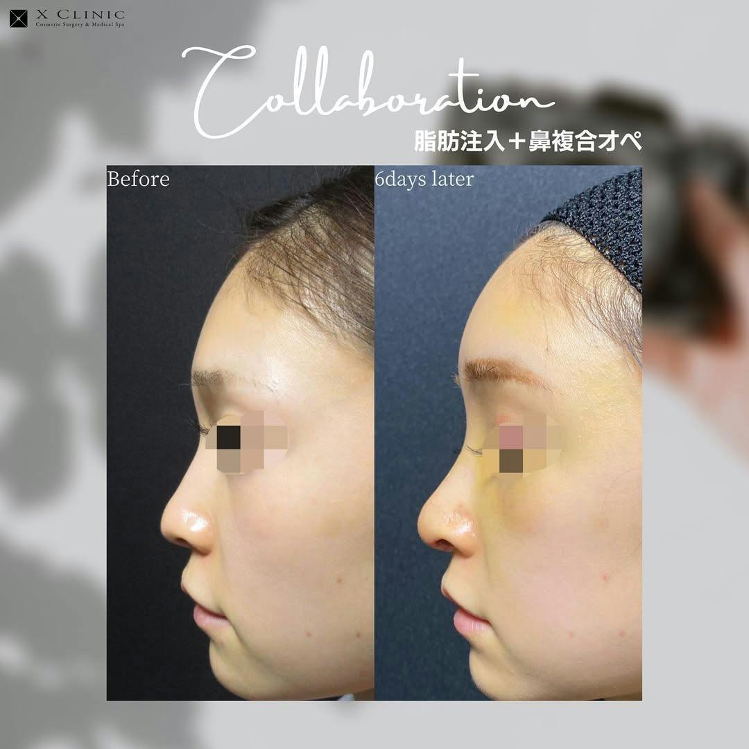 【女性・輪郭】脂肪注入+鼻複合オペ_before_aftar