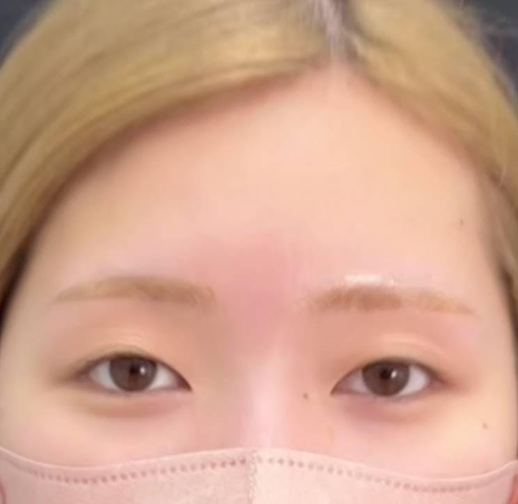 湘南美容クリニック 新宿本院で二重埋没法：クイックコスメティークシングルを受けたみにょんさんの写真