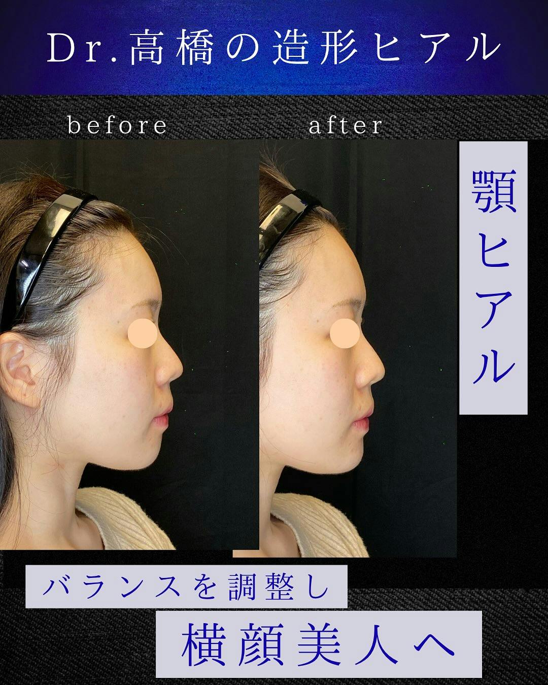 【女性・顎】顎ヒアル_before_aftar
