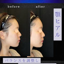 【女性・顎】顎ヒアル_before_aftar