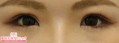 【女性・目元】全切開法二重術、目頭切開プレミアム_before