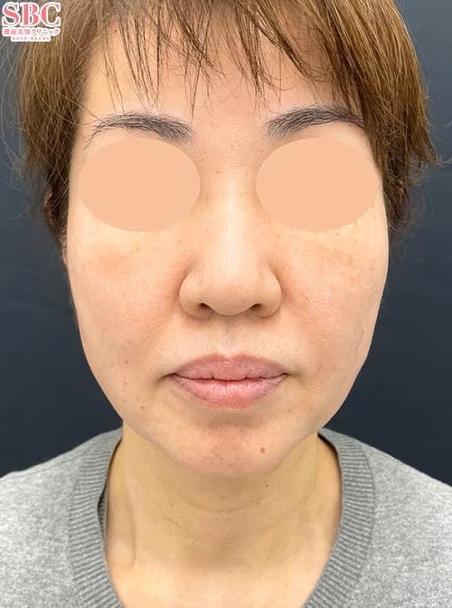 【女性・輪郭】Aquicell（アキーセル）脂肪吸引 ジョールファット除去術 メーラーファット除去術_aftar