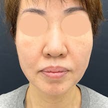 【女性・輪郭】Aquicell(アキーセル)脂肪吸引 ジョールファット除去術 メーラーファット除去術_aftar