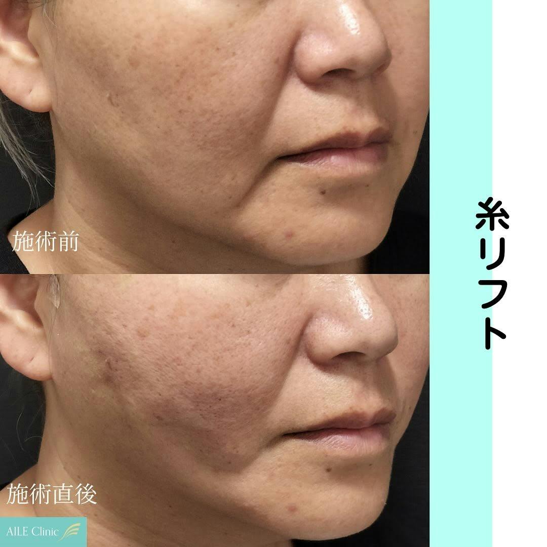 【女性・小顔】糸リフト_before_aftar