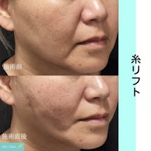 【女性・小顔】糸リフト_before_aftar